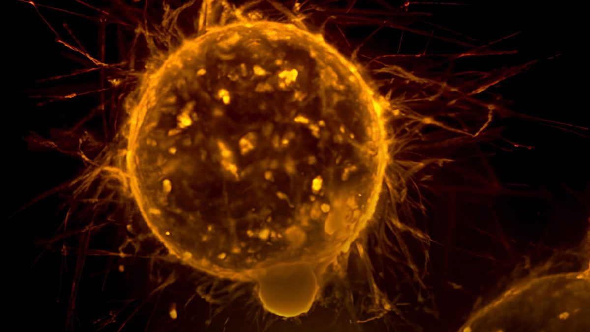 Câncer: cientistas brasileiros descobrem 'freio biológico' que paralisa o tumor e impede a metástase