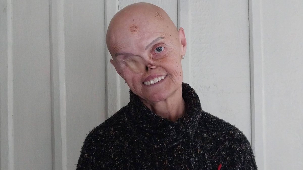 ‘Me chamam de monstro e de ET’: mulher que enfrentou 73 cânceres emociona o país e recebe onda de solidariedade