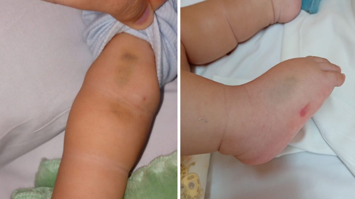 ‘Meu filho chorava de dor’: famílias denunciam falhas em atendimento pediátrico e hospital abre investigação em SC