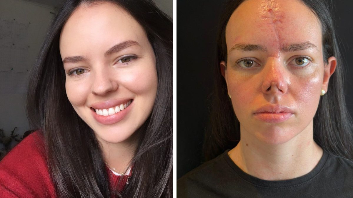 ‘Soltei o cinto para atender minha filha’: doula de SC revela detalhe de acidente que levou à reconstrução facial