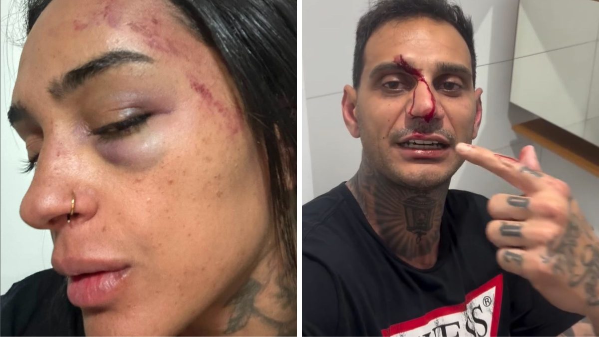 ‘Me espancou’: mulher denuncia parceiro por agressão e homem alega legítima defesa em Florianópolis