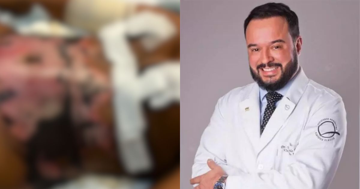 Paciente que teve 30% do corpo queimado por cirurgião 'X-tudo' em SC deve R$ 1 milhão em despesas médicas: 'Ele segue atendendo'
