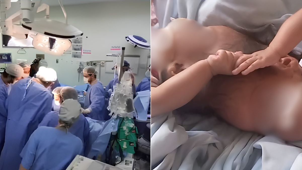 Após 15 horas de cirurgia, morrem gêmeas siamesas que nasceram unidas pela cabeça