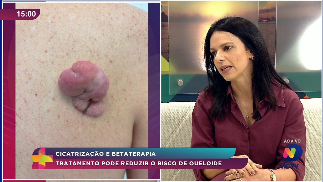 Betaterapia pode ajudar a reduzir risco de queloide após cicatrização