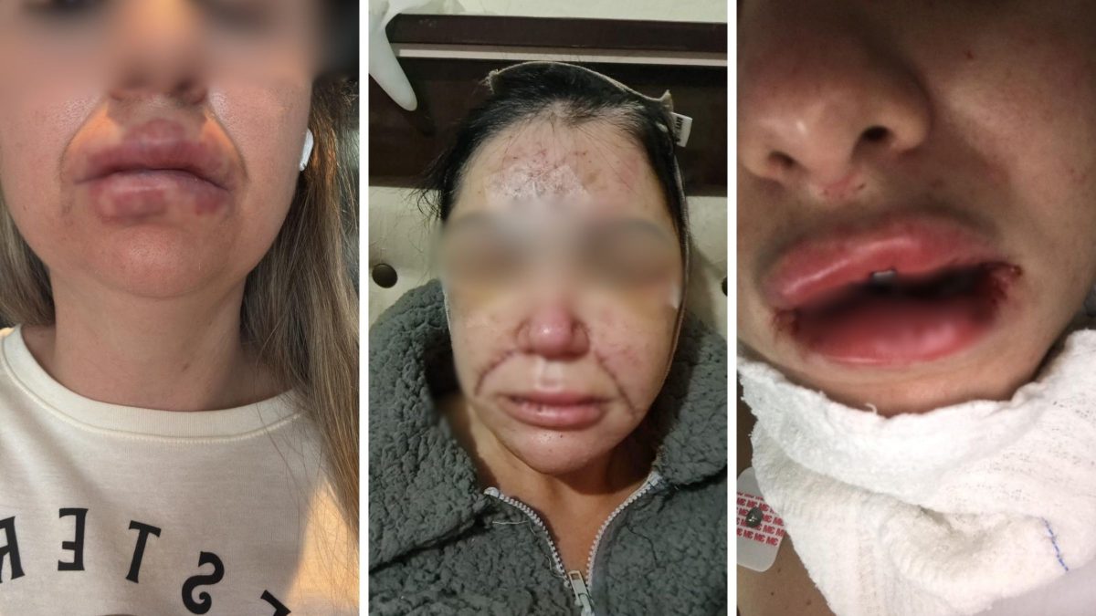 Uso de substância proibida em clínica estética de SC teria deformado rostos e necrosado bocas de clientes